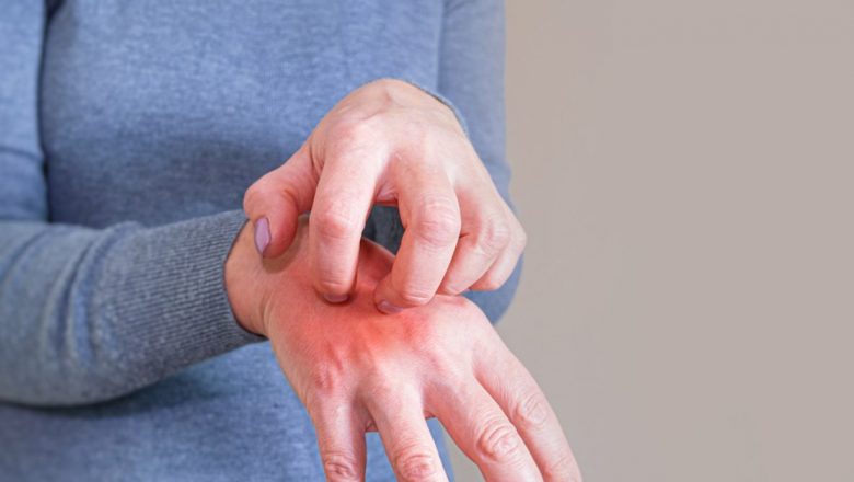 Scabia: Înțelegerea infestării, prevenirea și implicațiile asupra sănătății publice