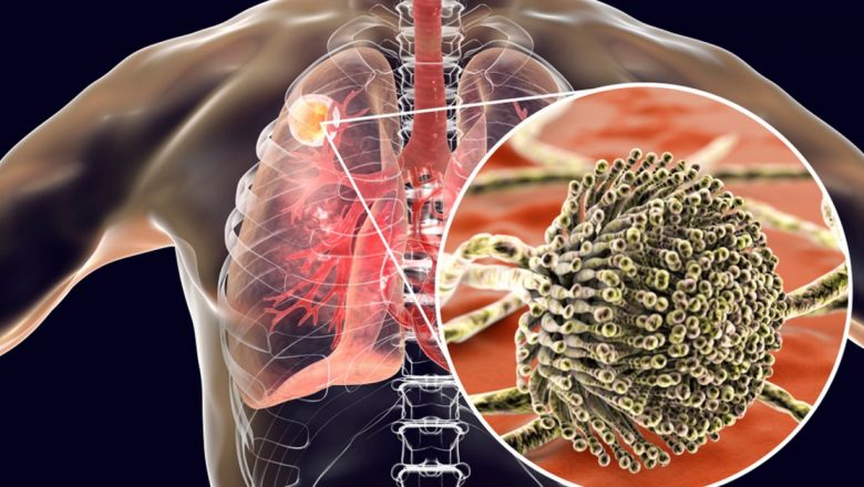 Răspândirea Aspergillus fumigatus: O amenințare emergentă la sănătatea publică globală