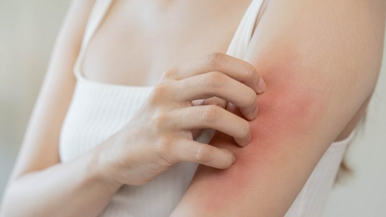Molluscum Contagiosum: O Analiză Detaliată a Infecției Cutante și a Impactului său Asupra Sănătății Publice