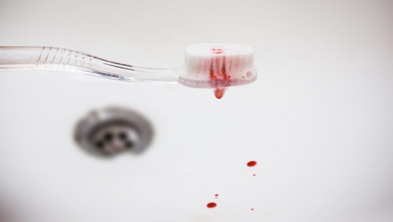 Sângerările gingivale: cauze, implicații și soluții pentru o sănătate dentară optimă