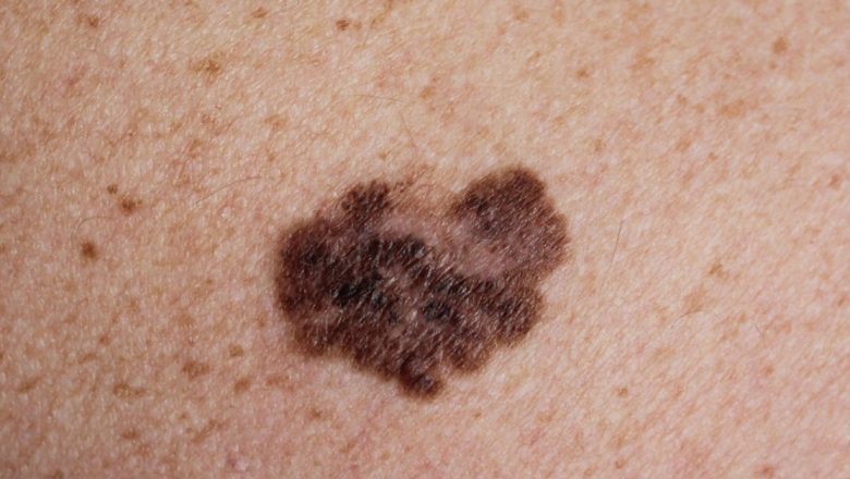 Cancerul de piele: Semnele de alarmă și importanța diagnosticării precoce