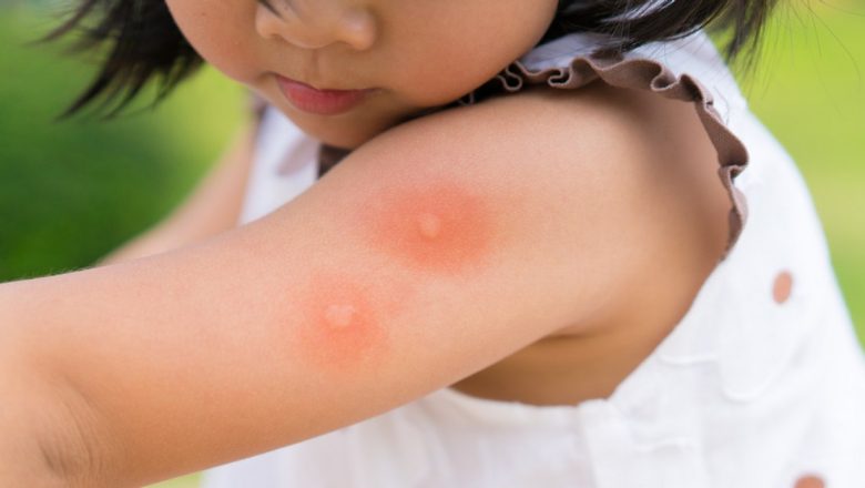 Impactul înțepăturilor de țânțari asupra copiilor: de ce sunt mai vulnerabili și cum ne putem proteja