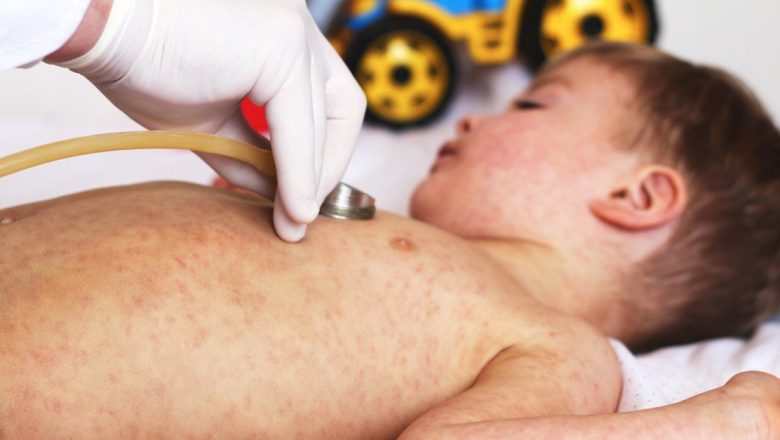 Rujeola la copii: Avertismente esențiale și impactul vaccinării asupra sănătății publice