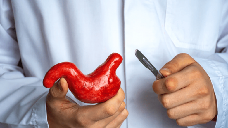 Impactul Chirurgiei Bariatrice Asupra Riscurilor de Cancer: O Analiză Detaliată
