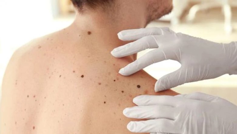 Riscurile transformării alunițelor în cancer: ce trebuie să știm pentru o prevenție eficientă