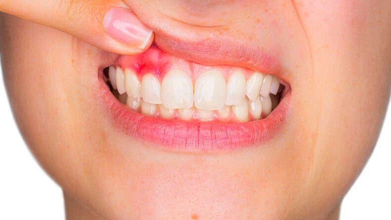 Parodontoza: O privire detaliată asupra unei afecțiuni dentare devastatoare
