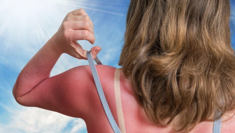 Ghid complet pentru tratarea arsurilor solare: Remedii naturiste și sfaturi esențiale