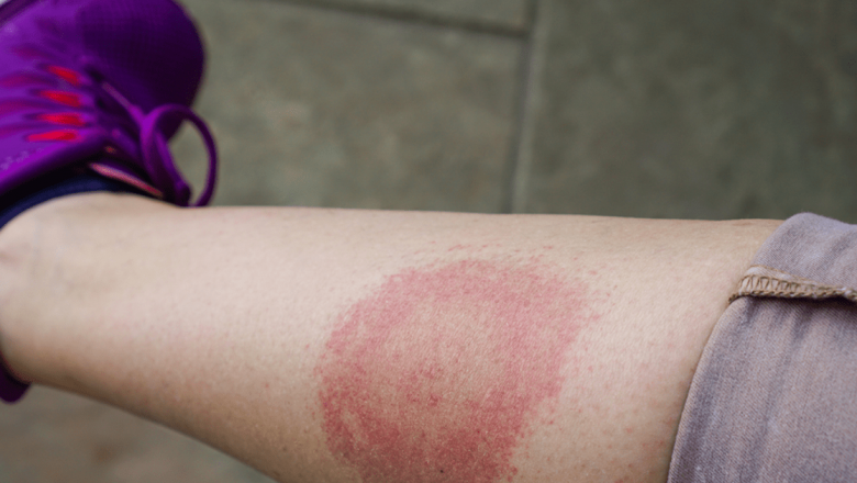 Boala Lyme: Un ghid complet despre simptome, complicații și prevenție