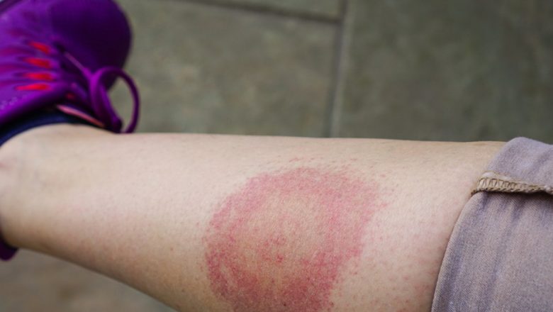 Boala Lyme: Simptome, Complicații și Măsuri de Prevenire în Fața unei Amenințări Crescânde