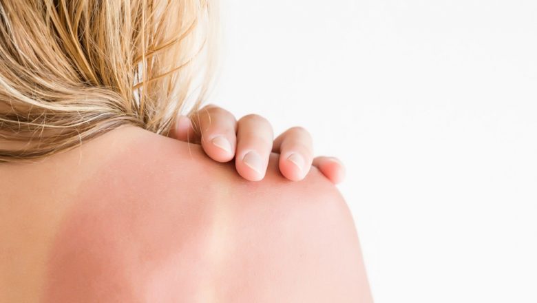 Ghidul Complet pentru Tratarea Arsurilor Solare: Remedii Naturale și Sfaturi Preventive