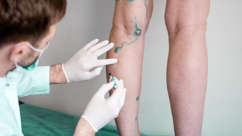 Tratamentul modern al varicelor: soluții eficiente fără necesitatea internării