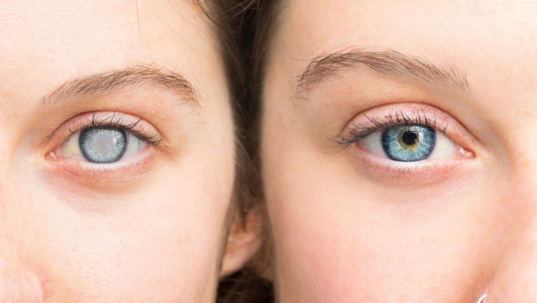 Cataracta: Simptome, Prevenție și Impactul Asupra Vederii
