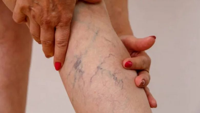 Telangiectaziile: Înțelegerea Venele de Păianjen și Impactul Expunerii la Soare