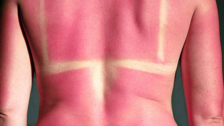 Leacuri Naturale pentru Pielea Arsă de Soare: Cum Să Te Îngrijești Corect