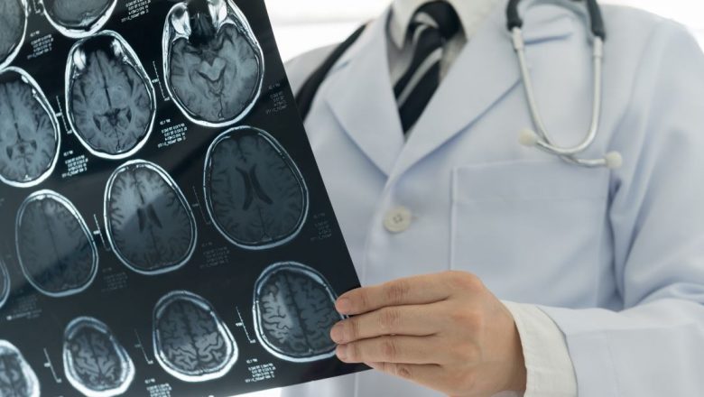 Scleroza multiplă: O privire detaliată asupra bolii cu o mie de fețe și confuziile sale diagnostice