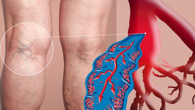 Impactul Ignorării Varicelor: Ce Riscuri Îți Asumi și Cum Poți Preveni Complicațiile