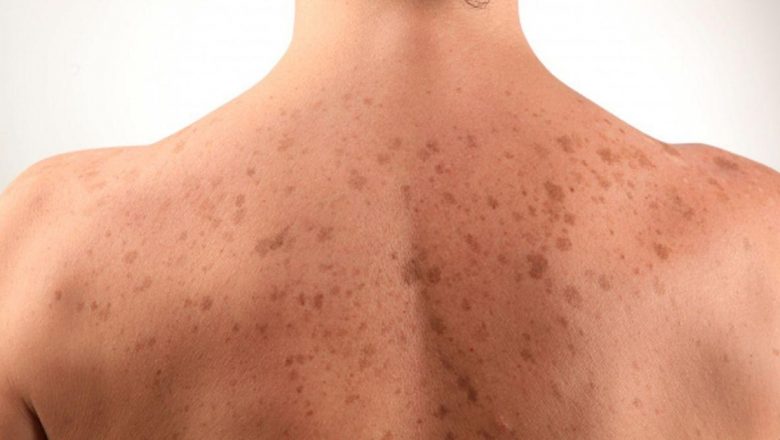 Petele de pe piele: Semnale de alarmă pentru sănătate și estetica personală