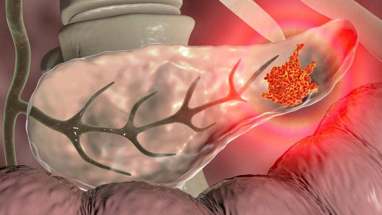 Cancerul pancreatic: O provocare diagnostică și o luptă pentru viață