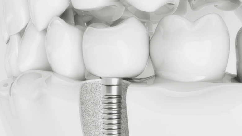 Implantul dentar: soluția ideală pentru înlocuirea dinților pierduți