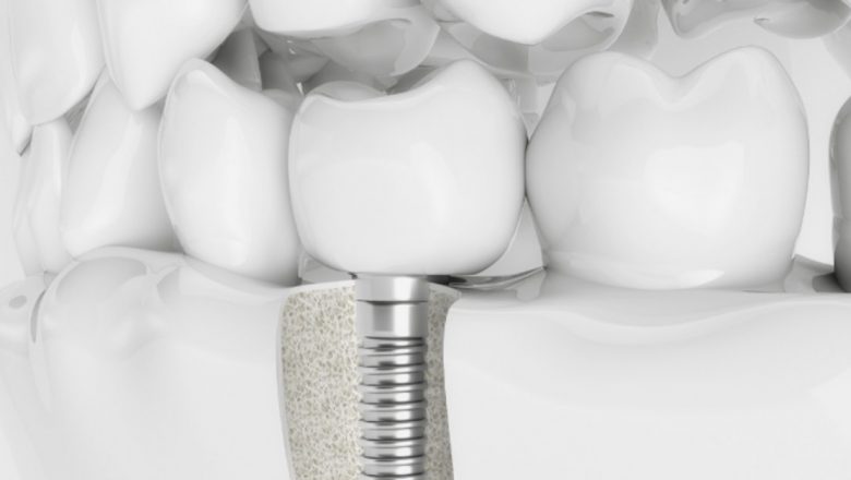 Implanturile dentare: Soluția ideală pentru înlocuirea dinților pierduți