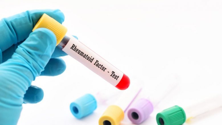 Diagnosticarea artritei reumatoide: Rolul testului factorului reumatoid în identificarea bolii autoimune