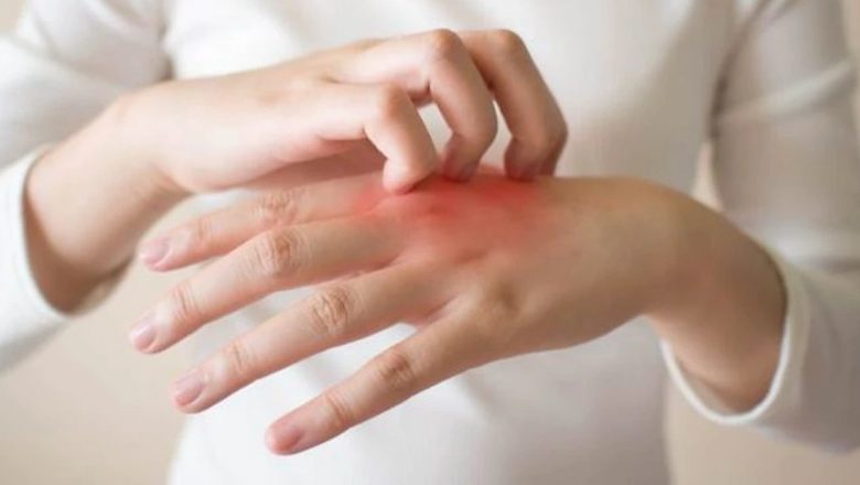 Dermatita Atopică: O Afecțiune în Creștere Care Afectează Generații Întregi