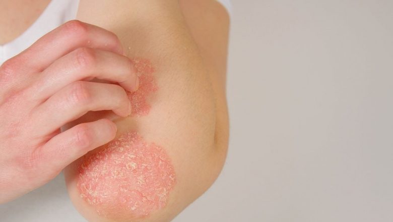 Tratamente Naturale Eficiente pentru Psoriazis: O Abordare Integrativă