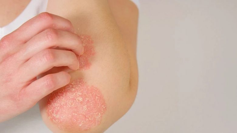 Psoriazisul în România: O privire detaliată asupra prevalenței, diagnosticării și impactului social