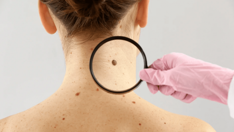 Consultații Dermatologice Gratuite: O Inițiativă Benefică pentru Sănătatea Pielii în București
