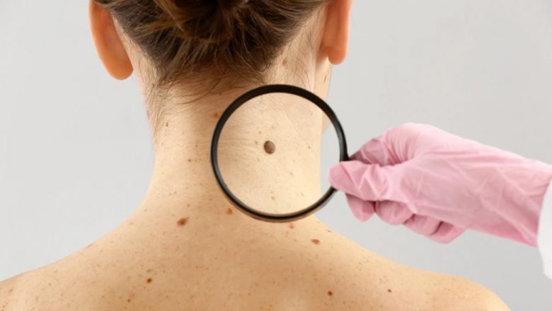 Consultații dermatologice gratuite în Sun Plaza: O oportunitate de a înțelege sănătatea pielii tale