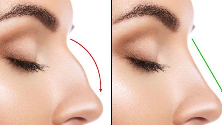 Rinoplastia la diferite vârste: Riscuri, beneficii și perspective