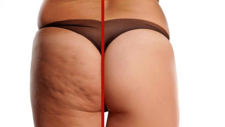 Celulita: Cauze, Tratament și Impactul Asupra Esteticii Feminină