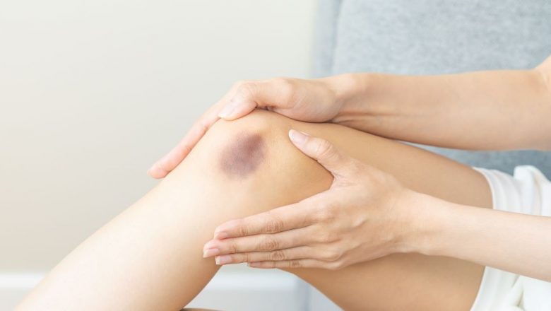 Vânătăi Apărute Din Senin: Cauze, Implicații și Ce Trebuie Să Știi