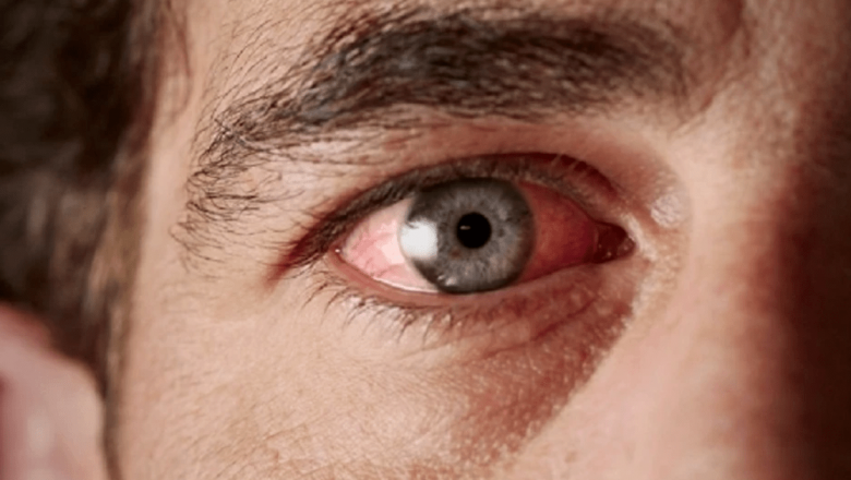 Glaucomul: O Afecțiune Silențioasă Care Poate Duce la Orbire și Semnele Care Trebuie Să Ne Alarmeze