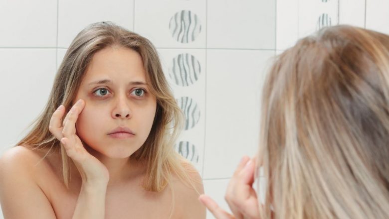 Cearcănele: Semne ale unor probleme de sănătate sau doar oboseală?