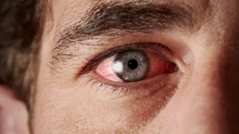 Glaucomul: O amenințare tăcută pentru vedere și sănătatea oculară