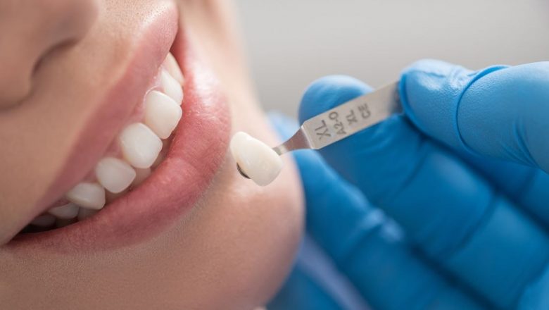 Coroana dentară: Durabilitate, tipuri și impact asupra sănătății orale