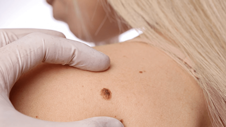 Importanța controalelor dermatologice gratuite: Oportunitatea de a depista melanomul la timp