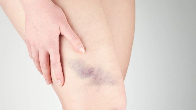 Purpura Trombocitopenică Imună: O Afecțiune Rară cu Implicații Severe