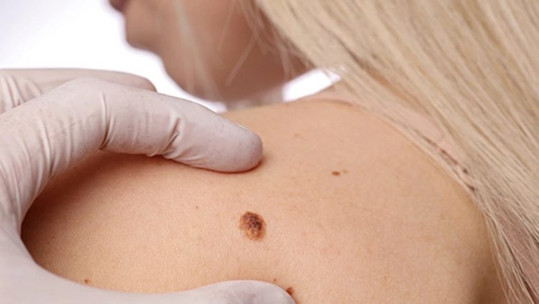 Campania Națională pentru Verificarea Alunițelor: O Inițiativă Esențială în Combaterea Melanomului
