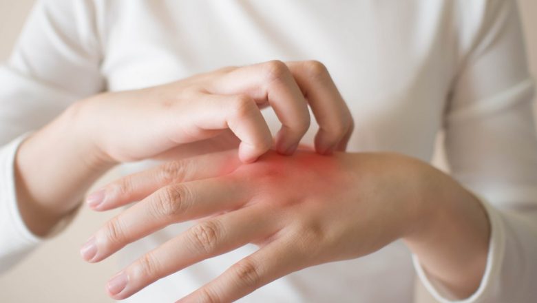 Ghid complet despre scabie: Cum să recunoști, să tratezi și să previi această infecție cutanată