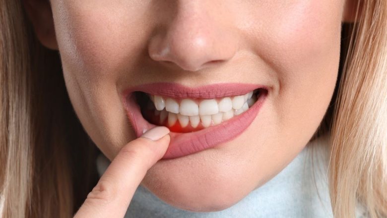 Parodontoză: Înțelegerea, Prevenția și Tratamentul unei Afecțiuni Cronice