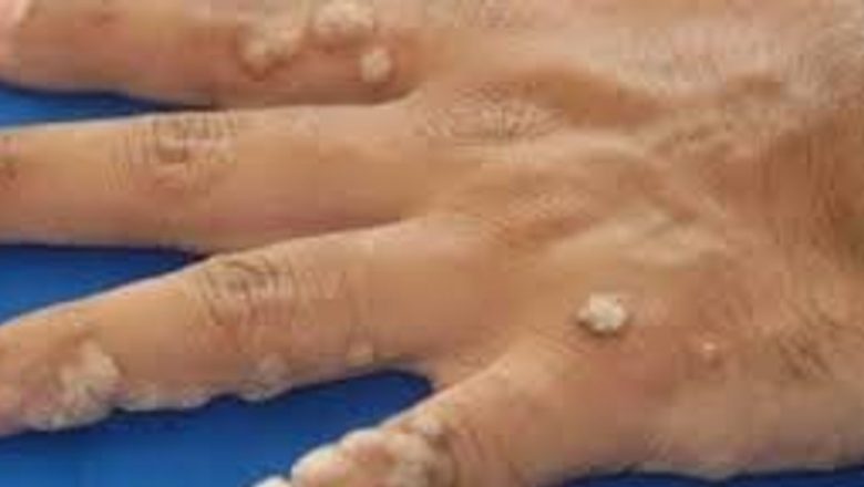 Remedii Naturiste Eficiente pentru Negi: Soluții Delicate pentru O Problemă Comună