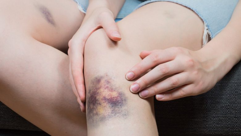 Eficiența pastei de dinți în tratarea vânătăilor: mit sau realitate?