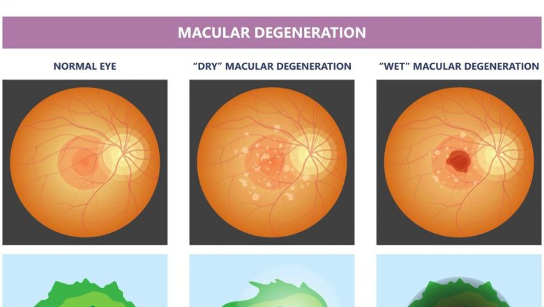 Degenerescența maculară: O privire detaliată asupra unei afecțiuni invizibile dar devastatoare