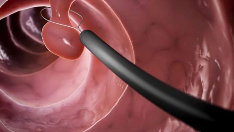 Polipii de colon: risc de transformare în cancer și simptomele de care trebuie să ne temem