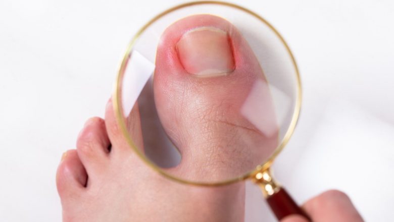 Unghia Încarnată: Cauze, Simptome și Tratament – Ghid Complet
