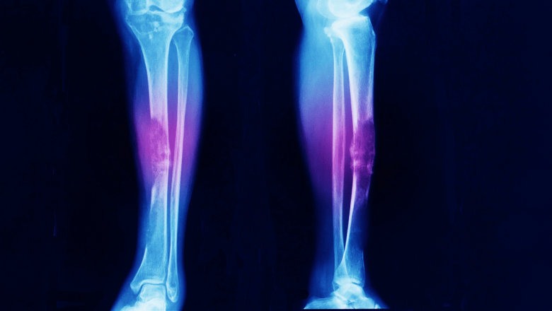 Simptomele Precoce ale Cancerului Osos: Ce Trebuie să Știm pentru a Detecta Boala din Timp