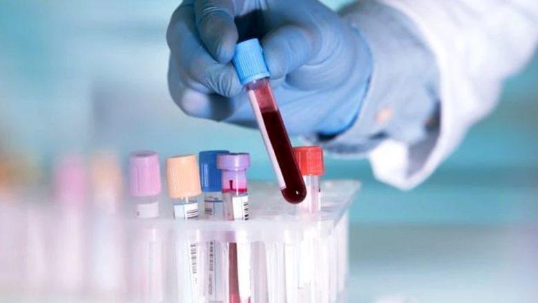 Bilirubina: Indicatori esențiali în diagnosticarea bolilor hepatice și nu numai