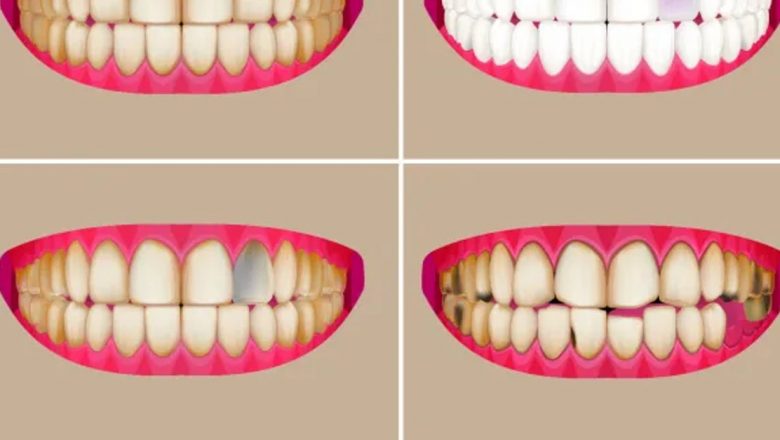 Culoarea dinților: Indicatori esențiali ai sănătății tale dentare și generale